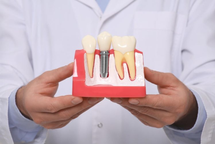 newmarket family dental dentist holding dental implant replica