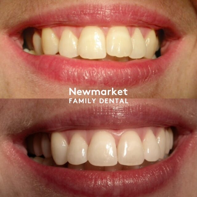From first visit to lifelong care! 🌻
Today’s smile makeover is more than a quick fix—it’s a step towards a lasting partnership. At Newmarket Family Dental, we’re here to ensure your smile stays as brilliant as the day it was transformed.

Even the smallest change—like a touch of orthodontics—can make a big difference. Whether it's subtle alignment or full smile design, we’re focused on lasting results and long-term care.

Looking for a smile that lasts? Let’s start this journey together!