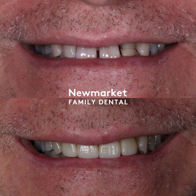 Today’s Transformation at Newmarket Family Dental

A smile that never fades! 
Today’s transformation brings new life to an old filling—now beautifully redone as part of a complete smile makeover. It’s a perfect example of how long-term care and attention to detail come together to create results that last.

At Newmarket Family Dental, we’re proud to support our patients through every stage of their smile journey with trust, care, and lasting results.

Want a smile that stands the test of time? Let’s begin your journey today!